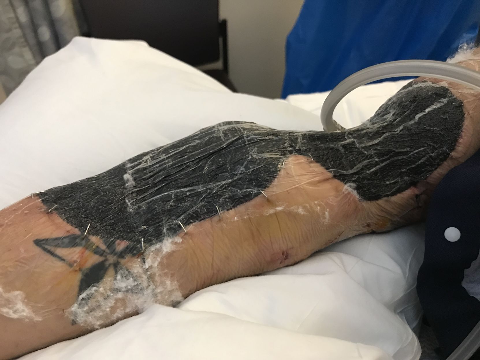 Tya Lucas arm